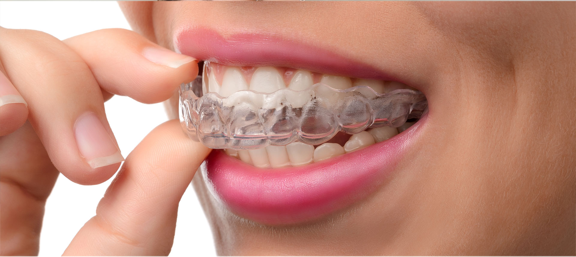 How to Financially “Brace” for Orthodontia