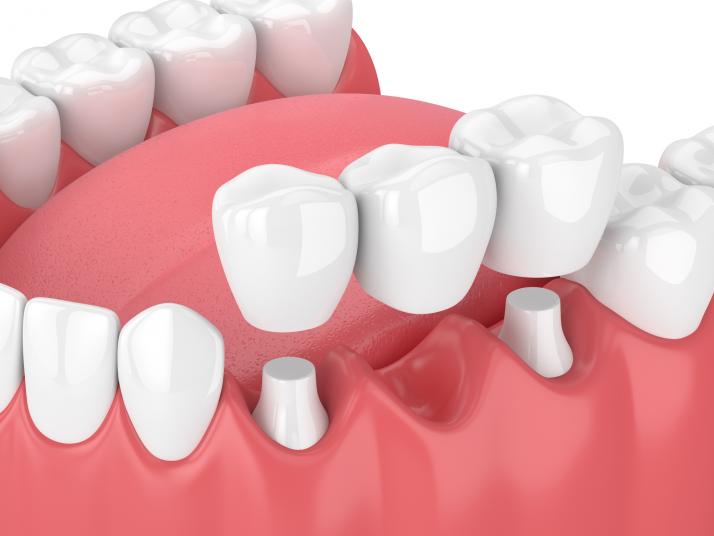 Why are Crowns and Bridge treatment Important? - My Primary Dental