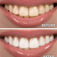before-after-teeth-whitening